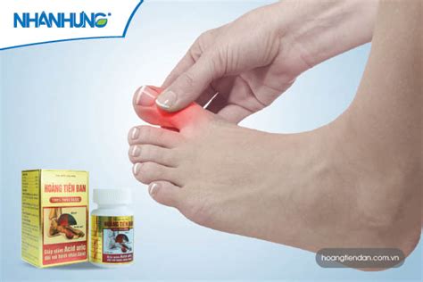 Dấu Hiệu Của Bệnh Gout Cách Nhận Biết Cấp độ Bệnh Gout Qua Từng Giai đoạn