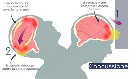 Commozione Cerebrale Sintomi Pericoli Cura