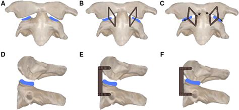 Schematic Diagram Of Operation A D Two Intraarticular Cages Were