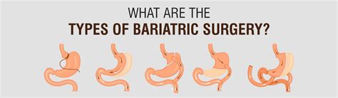 Bariatric Surgery Vs Liposuction Bariatric Surgeon India