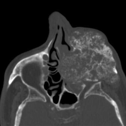 Chondrosarcoma Of The Maxilla Image Radiopaedia Org