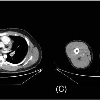 Computed Tomography Pulmonary Angiography And Venography Images