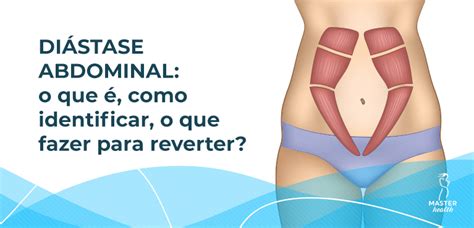 Di Stase Abdominal Como Identificar E Reverter Blog Master Health