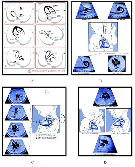 A Selected Views Of Fetal Cardiac Screening Recommended By Isuog B