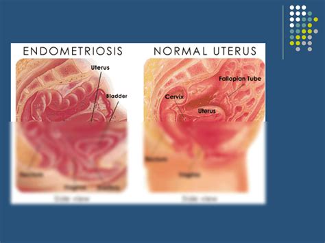 SOLUTION Endometriosis Signs Symptoms Classification Treatment Studypool