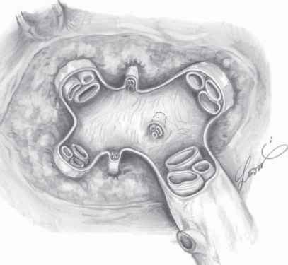 How To Tape The Whole Right Segmental Branch Glissonean Pedicle