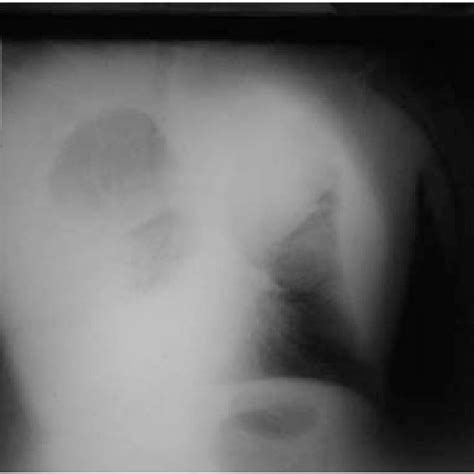 Posteroanterior Chest Radiograph Showing Right Pleural Effusion And A