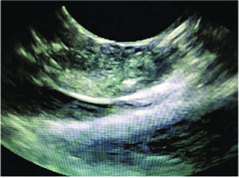 Eus View Of The Eus Rfa Probe Eus Endoscopic Ultrasound Rfa Download Scientific Diagram