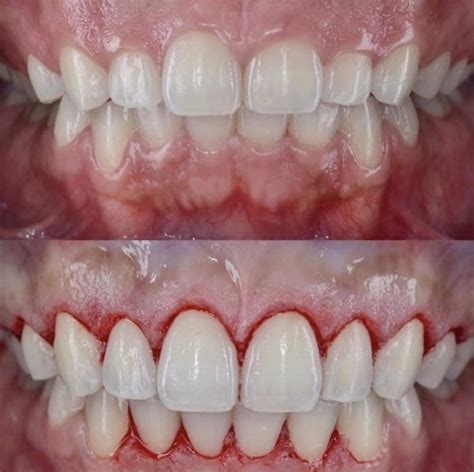 Gingivectomía en Costa Rica Mejora la Salud de tus Encías