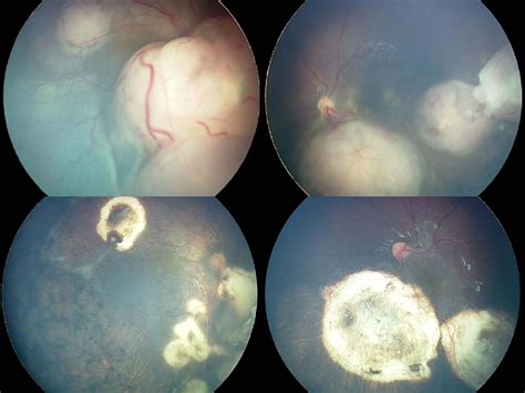 Bilateral Retinoblastoma Fundus Photography Captured With Retcam At A Download Scientific