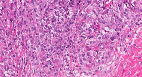 Epithelioid sarcoma | Ottawa Atlas of Pathology