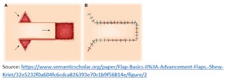 Ohima Blog Coding For Adjacent Tissue Transfers