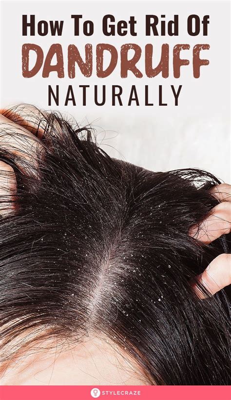 How To Get Rid Of Dandruff Naturally 18 Tips And Remedies Getting