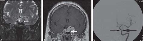 13 Modern Imaging Techniques For Meningiomas Neupsy Key