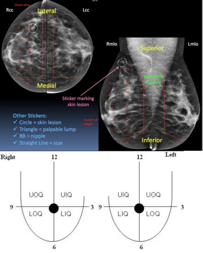 Mlo Mammography Positioning Angle