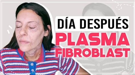 Plasma Pen Fibroblast D A Plasma Pen Antes Y Despu S