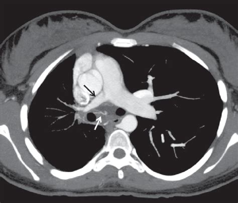 Axial Reconstruction Of Contrast Enhanced Chest Computed Tomography