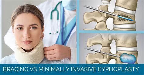 Treating Compression Fracture With Kyphoplasty Vs Bracing