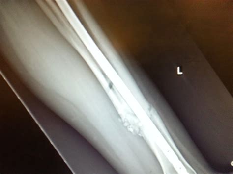 Kat's Broken Leg Adventures: X-Ray Update