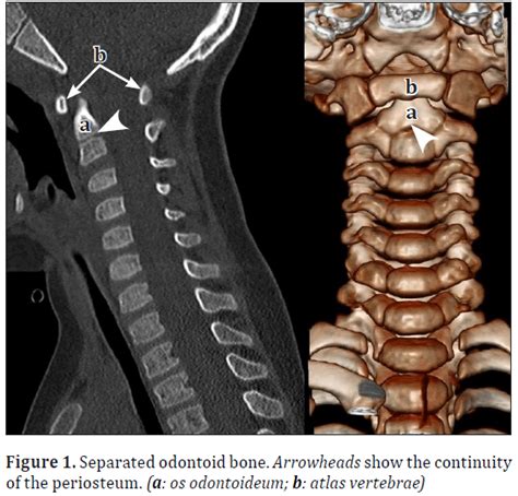 Odontoid Process Anatomy