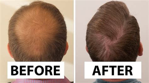 US Patient FUT Hair Transplant Great Before And After Results Dr