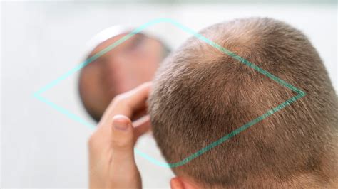 Alopecia Universal Síntomas y tratamientos Costo y precio