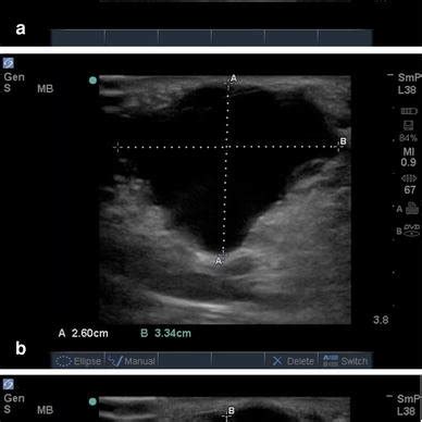 Ultrasound images of the anechoic structure and measurements | Download ...