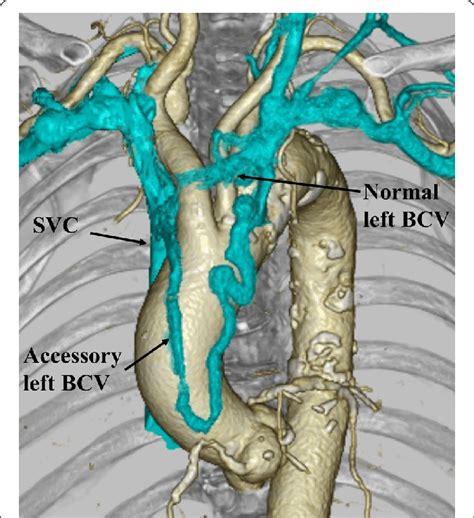 The 3d Reconstructed Image Of The Double Left Brachiocephalic Vein Download Scientific Diagram