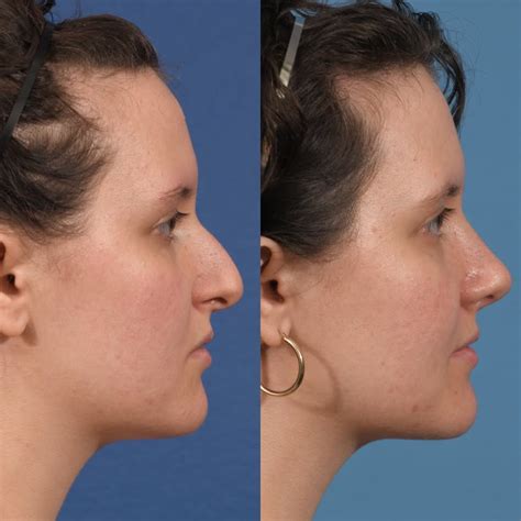 Septoplasty Before After