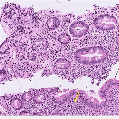 Cecum With Transmural Acute And Chronic Inflammation Focal Mucosal Download Scientific Diagram