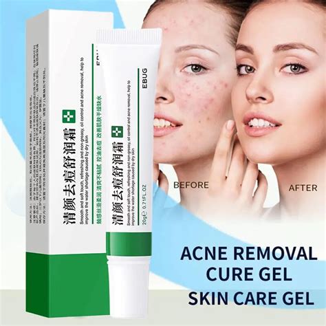 Acne Removal Cream