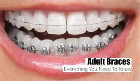 Damon Clear Braces vs Invisalign - Which is Right for You? | Top ...