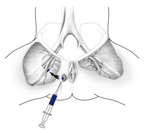 Sentinel Lymph Node Mapping Sentinel Lymph Nodes Are Localized By