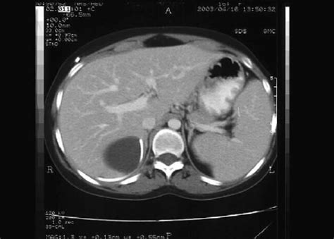 Abdominal CT Scan Reveals A Well Defined Subcapsular Hypodense Cystic