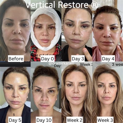 Vertical Restore Recovery Time Dr Karam In 2024 Skin Resurfacing