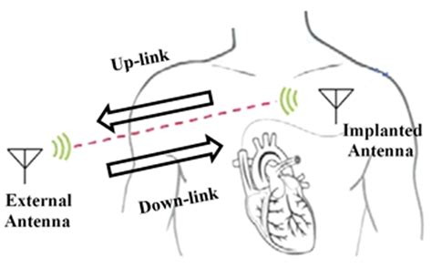 Signals Free Full Text Wireless Power Transfer Approaches For Medical Implants A Review