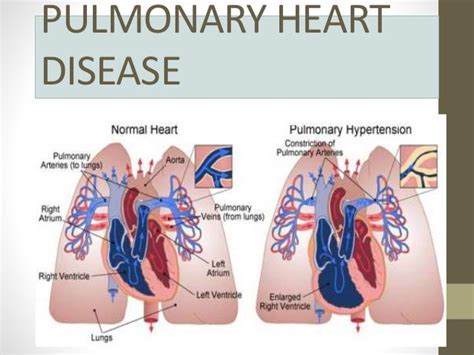 Pulmonary Heart Disease