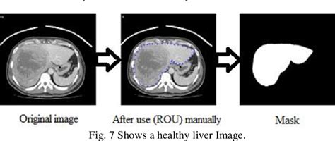 Figure 1 From Diagnosis Of Liver Tumor From Ct Images Using Unsupervised Classification With