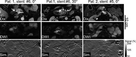 J Comparison Of The Dwi Images B 0 Mm 2 S Middle Row And The