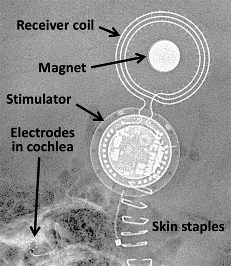 Cochlear implants MR safety - Questions and Answers in MRI