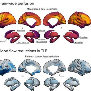 Cerebral Perfusion Changes In Temporal Lobe Epilepsy TLE A Cortex