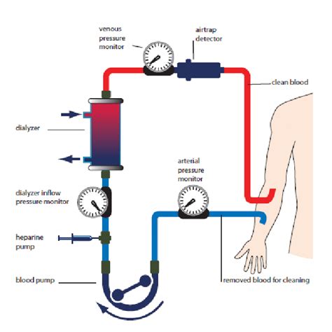 3 Schematic Visualization Of A Hemodialysis Circuit Download