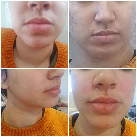 Nasolabial Fold Filler Before And After Vindicta