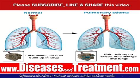 Pulmonary Edema Signs