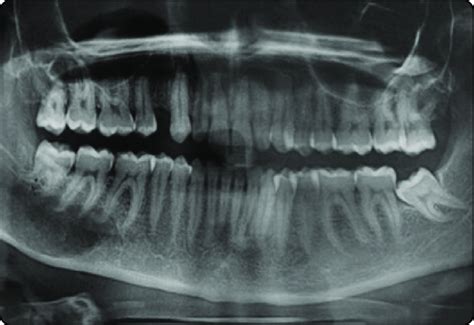 Preoperative Orthopantomograph Showing Well Defined Unilocular