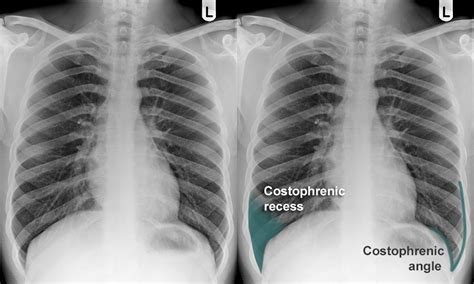 Costovertebral Angle