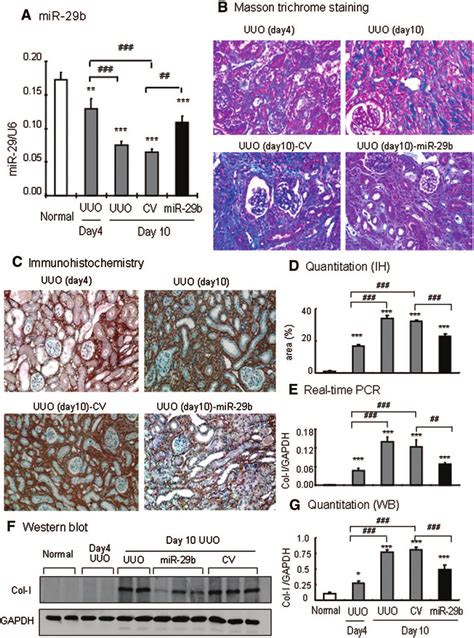 Ultrasound Microbubble Mediated Mir B Gene Transfer Holds Progressive