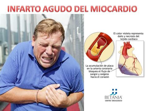 Medicina Cultural Infarto Agudo Del Miocardio