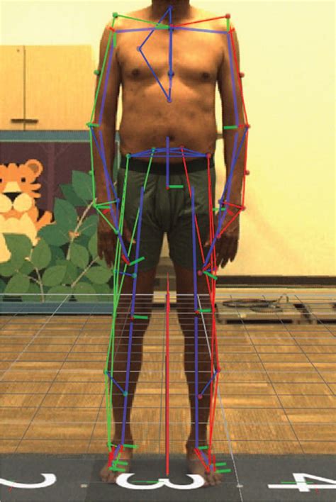 Evaluation of Gait and Functional Stability in Preoperative... : Spine