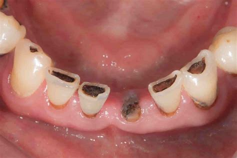 Caries Dental Qué es y Cómo prevenirla 2020